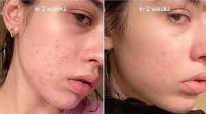 سرم ضد لک نیاسینامید 10% + ترانگزامیک 4% آنوا